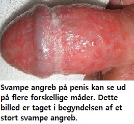 Penis svampeinfektion Svamp hos